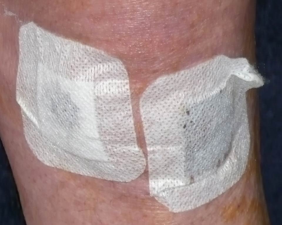 left knee (post-op) My left knee after the operation